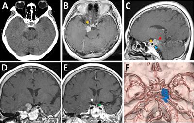 Endoscopic far-lateral supracerebellar infratentorial approach for resection of posterior clinoid meningioma: Case report and literature review